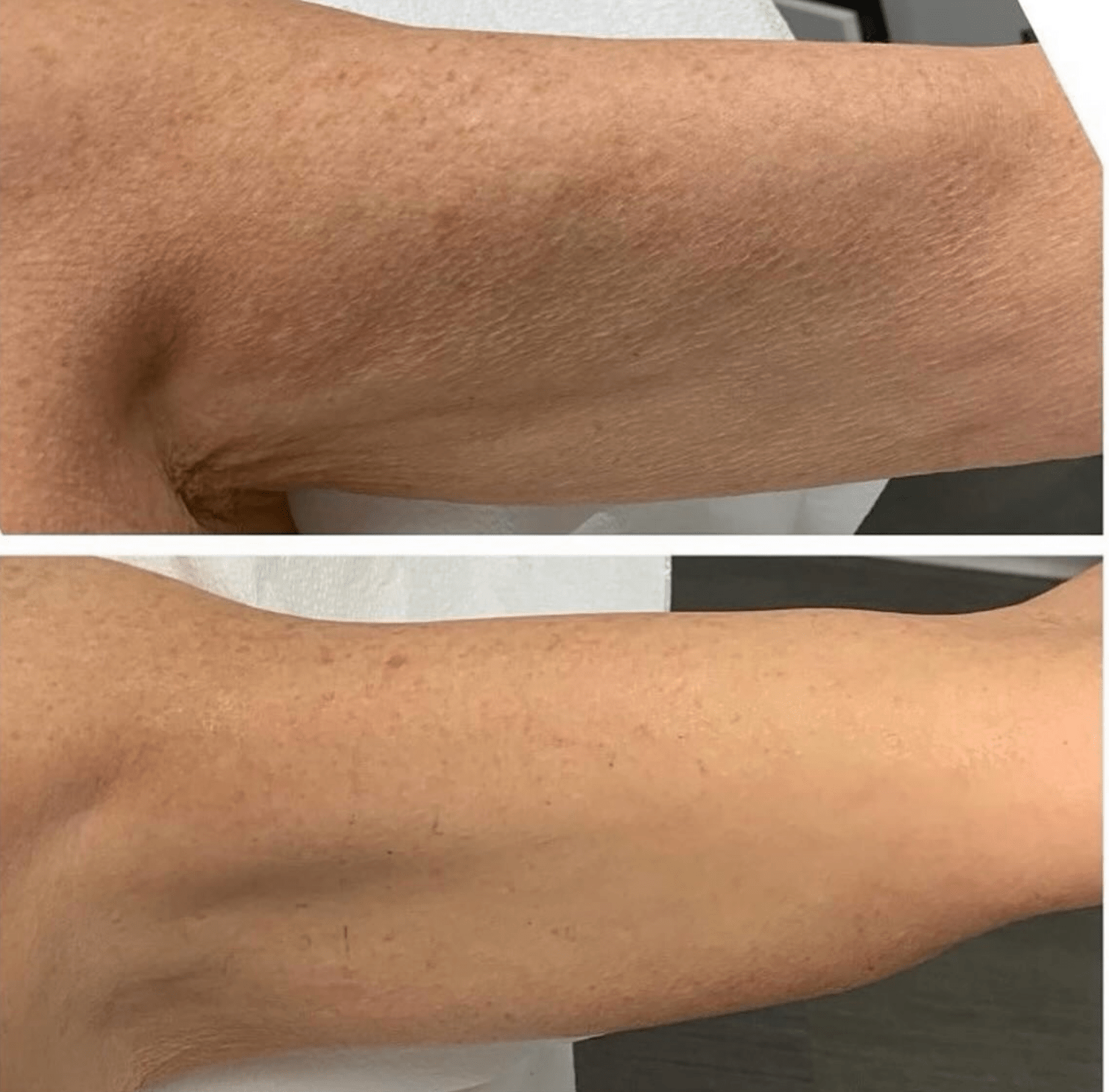 Epicutis Lipid Body Treatment