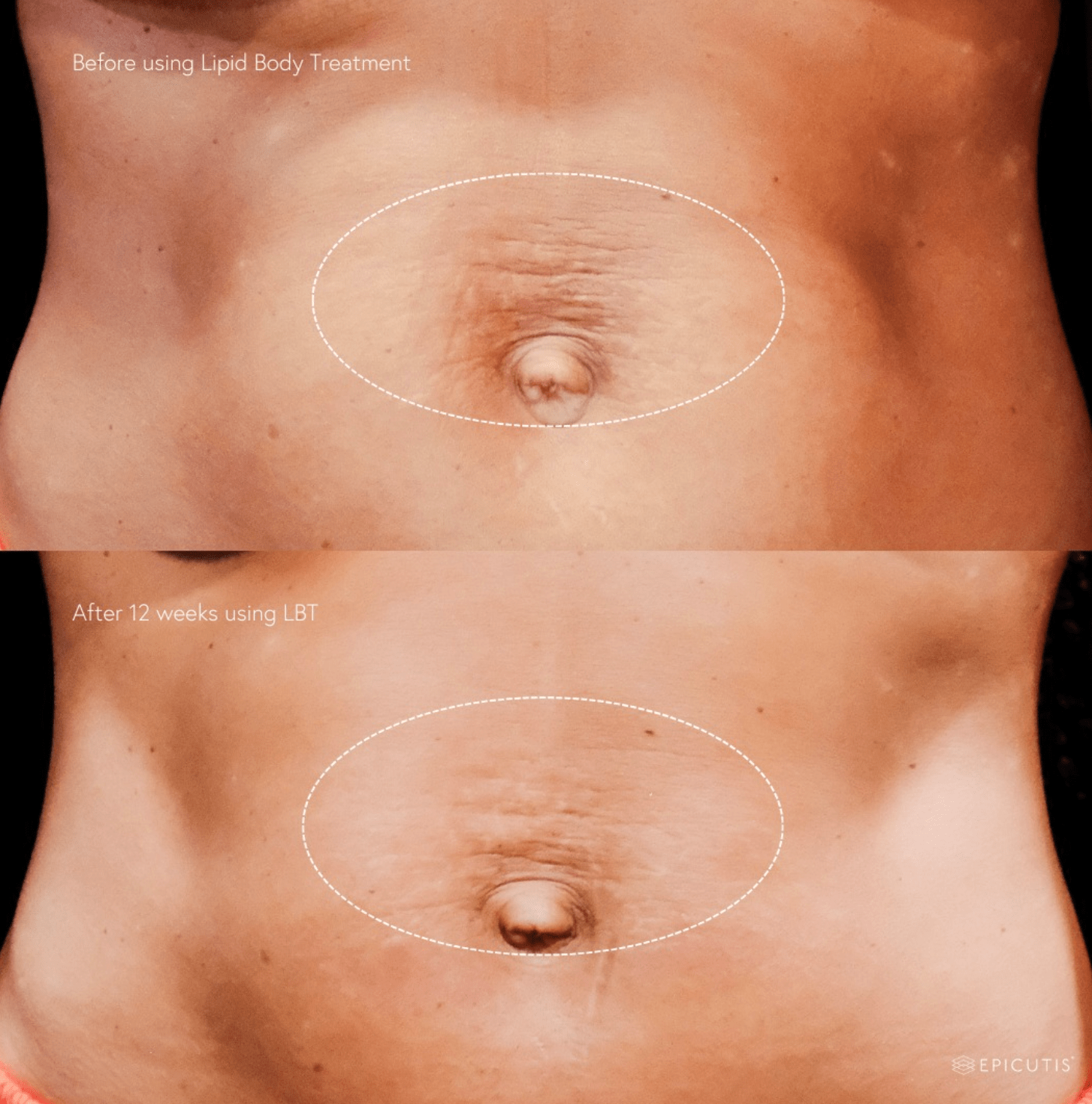 Epicutis Lipid Body Treatment